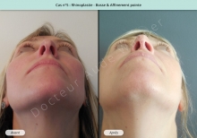 Résultat rhinoplastie, chirurgie de la bosse du nez et affinement de la pointe