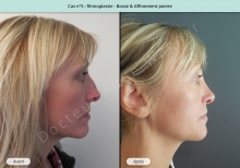 Résultat rhinoplastie, chirurgie de la bosse du nez et affinement de la pointe