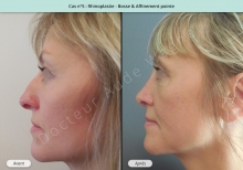 Résultat rhinoplastie, chirurgie de la bosse du nez et affinement de la pointe