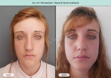 Résultat rhinoplastie, chirurgie de la bosse du nez et pointe tombante