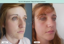 Résultat rhinoplastie, chirurgie de la bosse du nez et pointe tombante