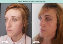 Résultat rhinoplastie, chirurgie de la bosse du nez et pointe tombante