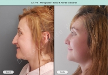 Résultat rhinoplastie, chirurgie de la bosse du nez et pointe tombante