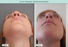 Résultat rhinoplastie, chirurgie de la bosse du nez et pointe tombante