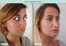 Résultat rhinoplastie, chirurgie de la bosse du nez