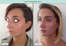 Résultat rhinoplastie, chirurgie de la bosse du nez