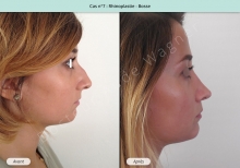 Résultat rhinoplastie, chirurgie de la bosse du nez