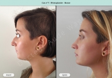 Résultat rhinoplastie, chirurgie de la bosse du nez