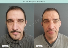 Résultat rhinoplastie, chirurgie d'une grosse bosse du nez