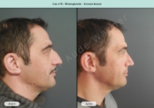 Résultat rhinoplastie, chirurgie d'une grosse bosse du nez