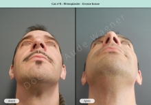 Résultat rhinoplastie, chirurgie d'une grosse bosse du nez
