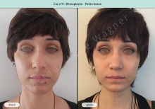 Résultat rhinoplastie, chirurgie d'une petite bosse du nez