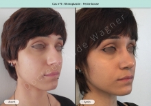 Résultat rhinoplastie, chirurgie d'une petite bosse du nez