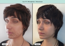 Résultat rhinoplastie, chirurgie d'une petite bosse du nez