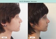 Résultat rhinoplastie, chirurgie d'une petite bosse du nez