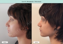 Résultat rhinoplastie, chirurgie d'une petite bosse du nez