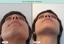 Résultat rhinoplastie, chirurgie d'une petite bosse du nez