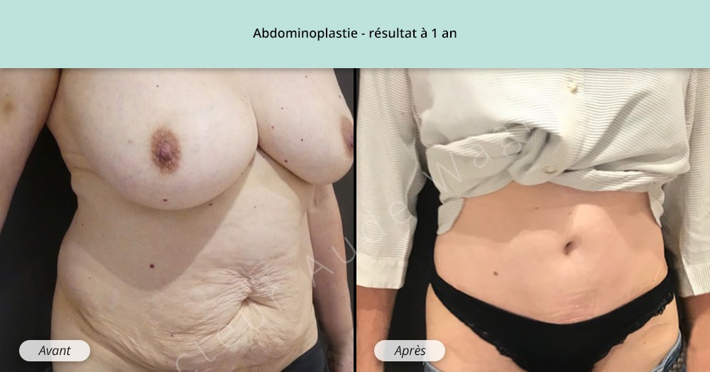 Abdominoplastie, plastie abdominale, lifting du ventre à Toulouse