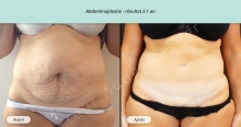 Cas n°1 résultat abdominoplastie à un an de face