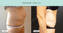 Cas n°1 résultat abdominoplastie à un an de profil droit