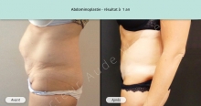 Cas n°1 résultat abdominoplastie à un an de profil gauche