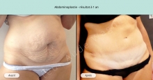 Cas n°1 résultat abdominoplastie à un an de face de trois-quarts droit