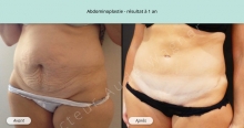 Cas n°1 résultat abdominoplastie à un an de face de trois-quarts gauche