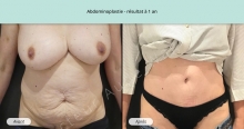 Cas n°2 résultat abdominoplastie à un an de face