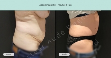 Cas n°2 résultat abdominoplastie à un an de profil droit