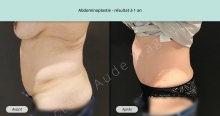 Cas n°2 résultat abdominoplastie à un an de profil gauche