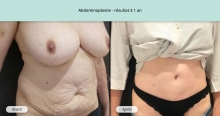 Cas n°2 résultat abdominoplastie à un an de face de trois-quarts droit