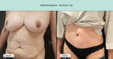 Cas n°2 résultat abdominoplastie à un an de face de trois-quarts gauche