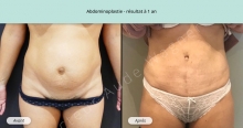 Cas n°3 résultat abdominoplastie à un an de face