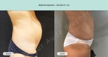 Cas n°3 résultat abdominoplastie à un an de profil droit