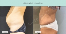 Cas n°3 résultat abdominoplastie à un an de profil gauche