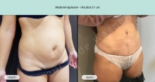 Cas n°3 résultat abdominoplastie à un an de face de trois-quarts droit