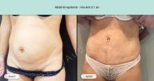 Cas n°3 résultat abdominoplastie à un an de face de trois-quarts gauche