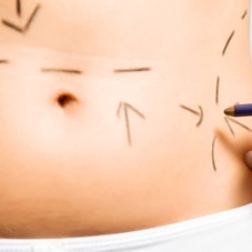 abdominoplastie-lifting-ventre-toulouse