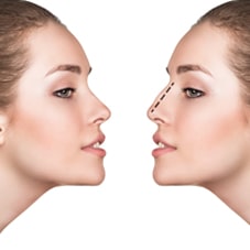 La rhinoplastie préservative ou preservation rhinoplasty