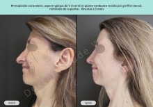 Cas n°2 résultat av ap de rhinoplastie secondaire ou chirurgie du nez à Toulouse