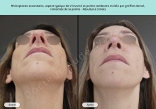 Cas n°2 résultat avant après de chirurgie esthétique du nez à Toulouse par le Dr Wagner