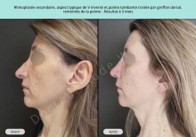 Cas n°2 résultat avant après de rhinoplastie secondaire ou chirurgie du nez à Toulouse