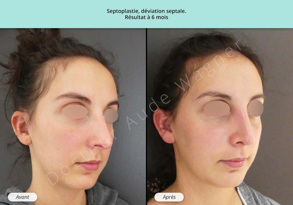 Septoplastie, Chirurgie déviation de la cloison nasale à Toulouse, 31