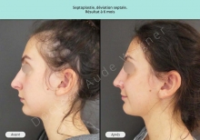 Cas n°2 resultat av ap de la septoplastie ou chirurgie de la cloison nasale à Toulouse