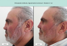 Cas n°1 résultat de rhinoplastie médicale, régularisation par dorsum à 1 an de profil gauche