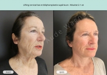 Cas n°3 résultat lifting cervico-facial à un an de face trois-quarts droit