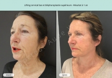 Cas n°3 résultat lifting cervico-facial à un an de face trois-quarts gauche