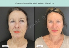 Cas n°3 résultat lifting cervico-facial à un an de face