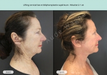 Cas n°3 résultat lifting cervico-facial à un an de profil droit