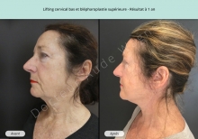 Cas n°3 résultat lifting cervico-facial à un an de profil gauche